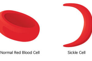 Art and the scourge of Sickle Cell Disease