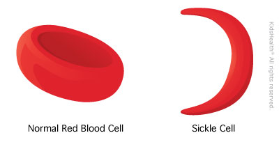 Art and the scourge of Sickle Cell Disease